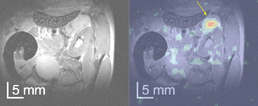 Image: A regular MRI scan (left) failed to detect a pancreatic tumor which was clearly highlighted by MRI performed after an injection of chemically altered glucose (right) (Photo courtesy of Weizmann)